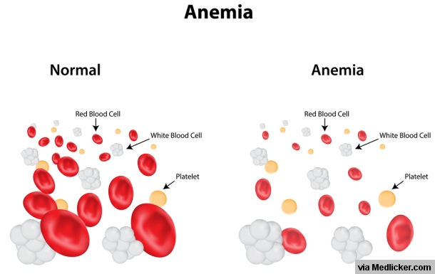 Iron Deficiency Anemia All You Need To Know 5657