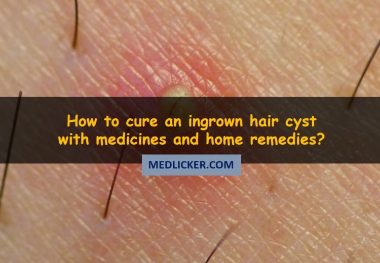 Ingrown hair cyst and how to cure it