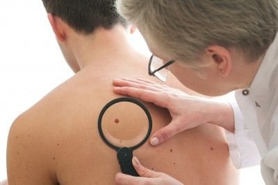 Skin Cancer: When to Worry About Your Mole