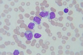 Akutní myeloidní leukémie: příčiny, příznaky, diagnostika a léčba