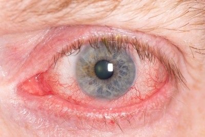 Zánět oční rohovky: příčiny, příznaky, diagnostika a léčba