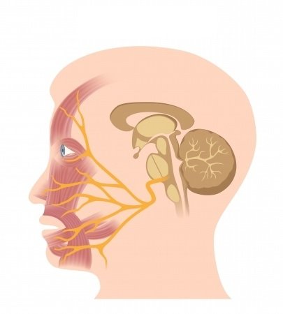 Obrna lícneho nervu: príčiny, príznaky, diagnostika a liečba