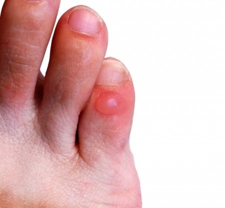 A Comprehensive Guide To Blisters: Symptoms, Treatment And Prevention