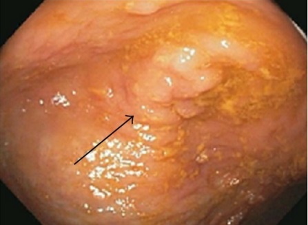 Ulcerative colitis found while performing an endoscopic procedure