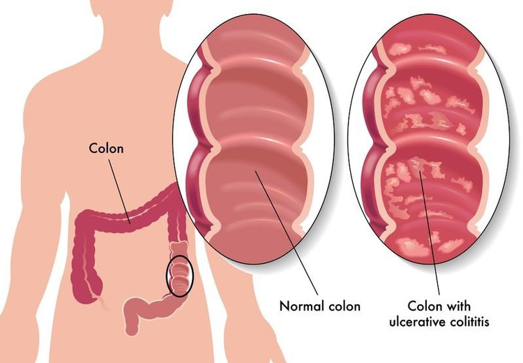 Ulcerative colitis: causes, symptoms, diagnosis and treatment