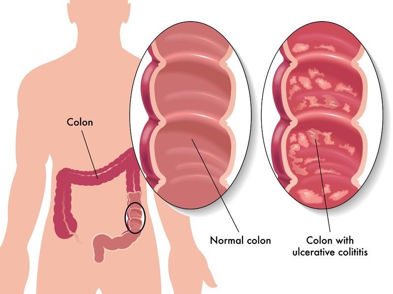 Ulcerative colitis: causes, symptoms, diagnosis and treatment