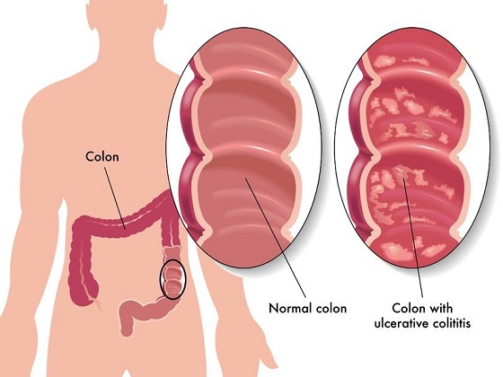 Ulcerative colitis: causes, symptoms, diagnosis and treatment diagram of colitis 