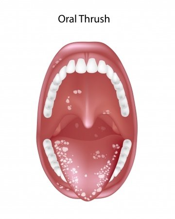 Diflucan symptoms not to ignore