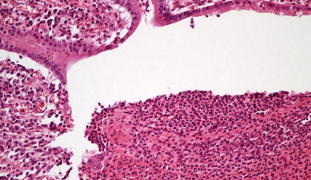 Histopathology quiz 6