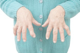 Rheumatoid arthritis: causes, symptoms, treatment and complications