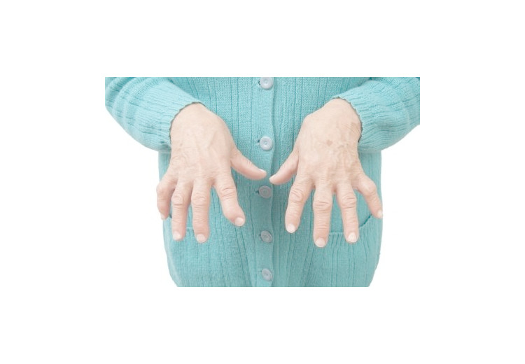 How doctors diagnose Rheumatoid Arthritis (RA)