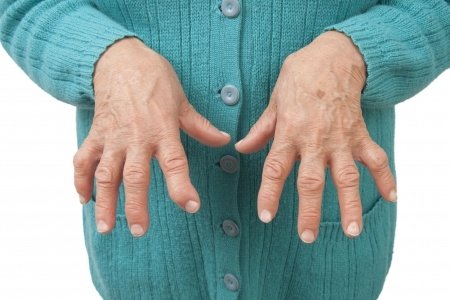 How doctors diagnose Rheumatoid Arthritis (RA)