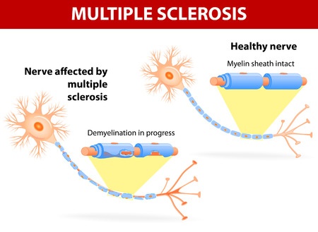 Multiple Sclerosis Diagram