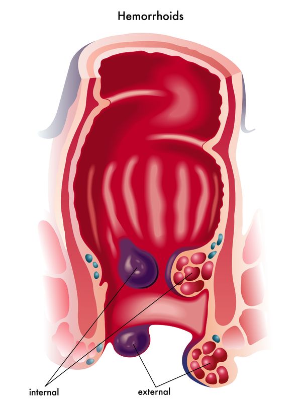 Hemorrhoids