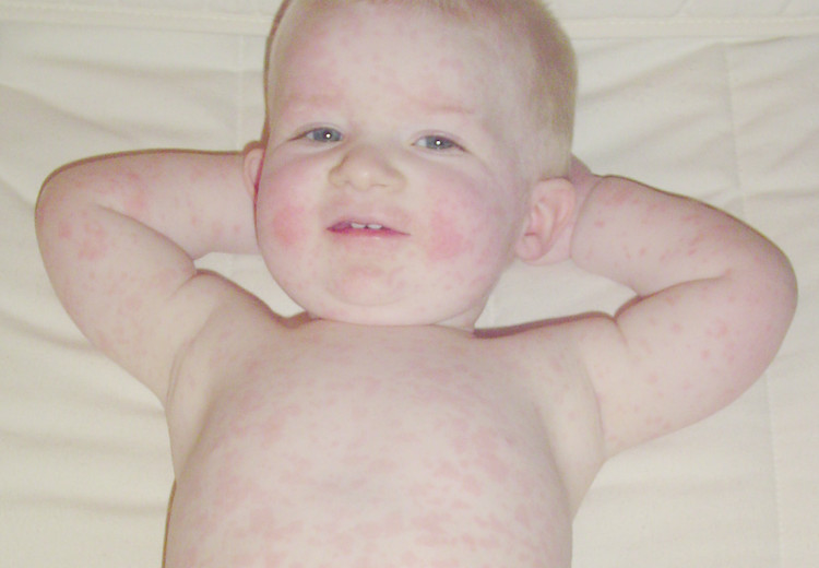 Fifth disease: causes, symptoms, diagnosis and treatment