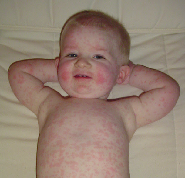 Fifth-Disease-Rash-16-months-old-boy