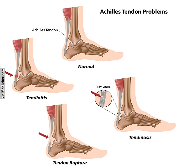 Image result for Achilles tendonitis Causes, Symptoms & Treatments