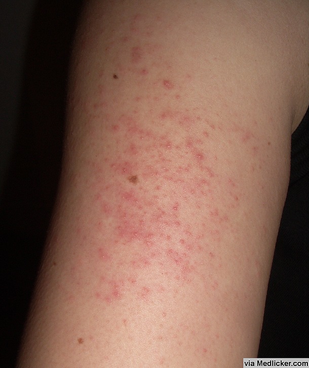 keratosis-pilaris-on-arm