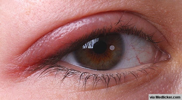 Blepharitis (Eye Stye) on right eye