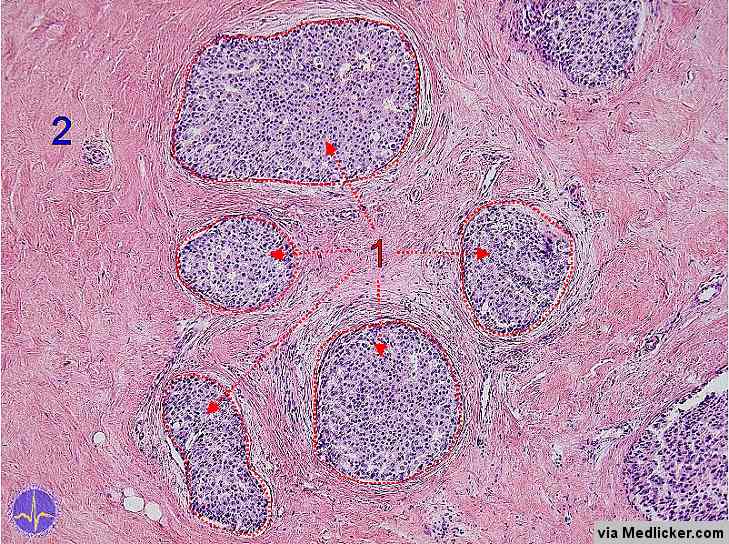 Ductal Carcinoma of Breast in HE staining