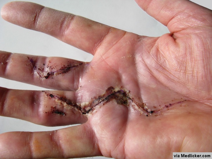 Une main après une opération de la maladie de Dupuytren