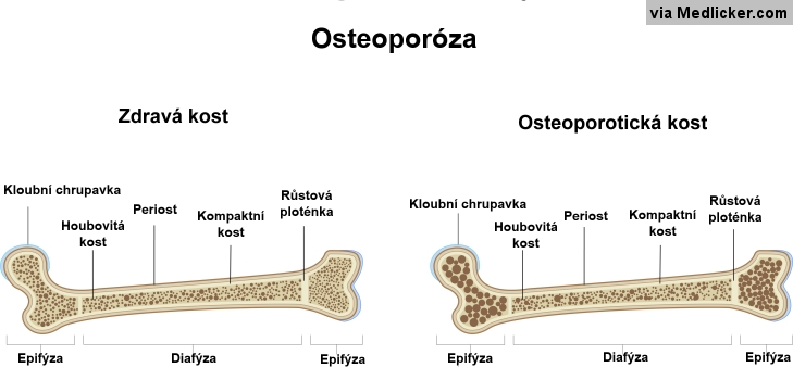 Osteoporóza v kosti - názorné vysvětlení