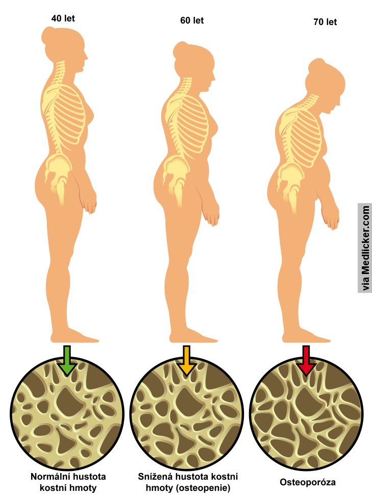 Osteoporóza a věk