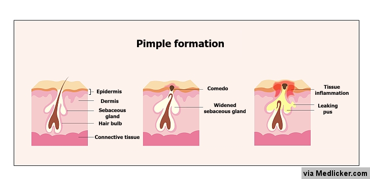 Pimple (zit) formation