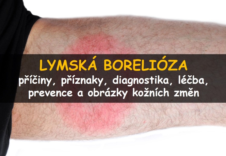 Lymská borelióza: příznaky, léčba a prevence