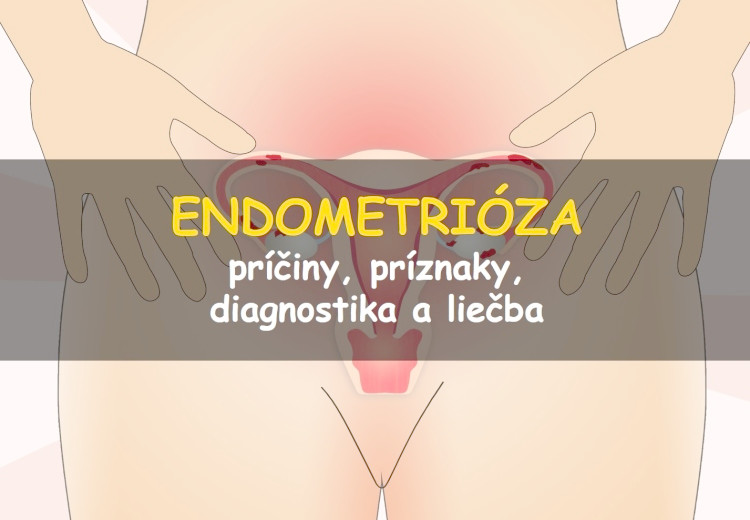 Endometrióza: príčiny, príznaky, diagnostika a liečba