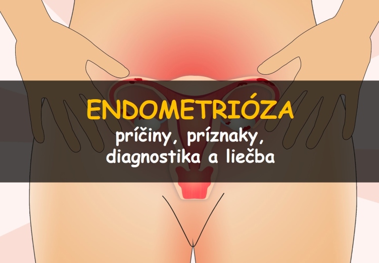 Endometrióza: príčiny, príznaky, diagnostika a liečba