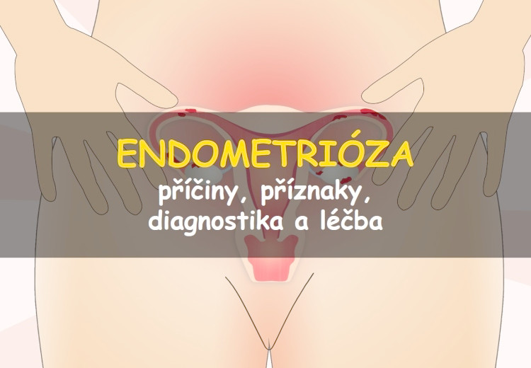 Endometrióza: příčiny, příznaky, diagnostika a léčba