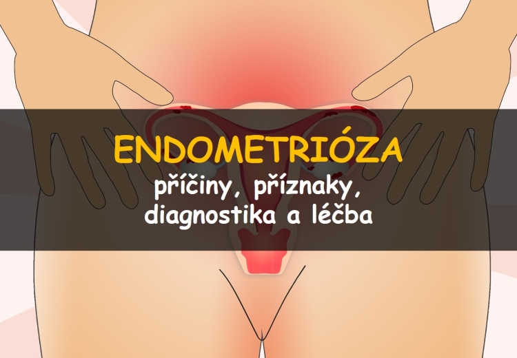 Endometrióza: příčiny, příznaky, diagnostika a léčba