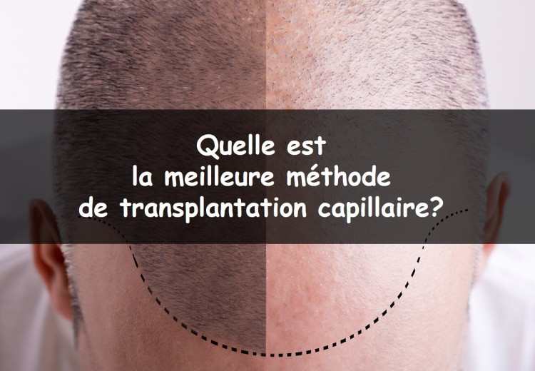 Quelle est la meilleure méthode de transplantation capillaire?