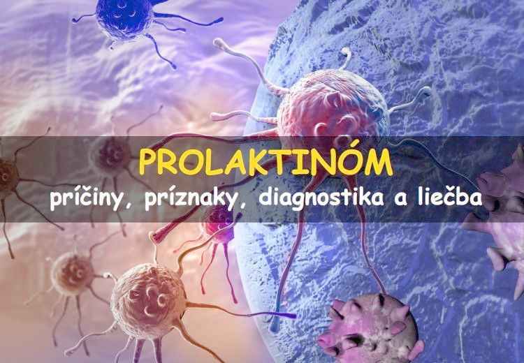 Prolaktinóm: príčiny, príznaky, diagnostika a liečba