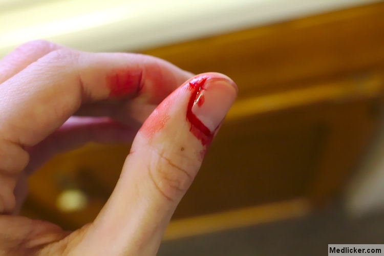 finger bleeding