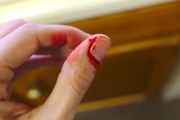 Bleeding finger