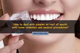 How to Deal with Pimples on Roof of Mouth