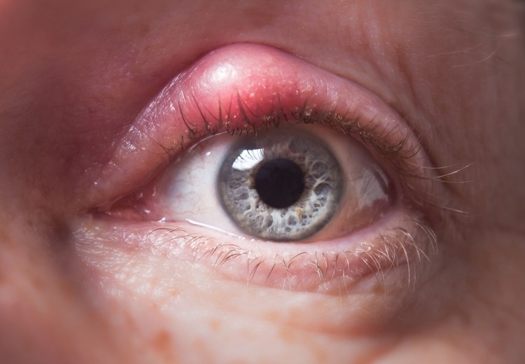 What causes red eyelids?