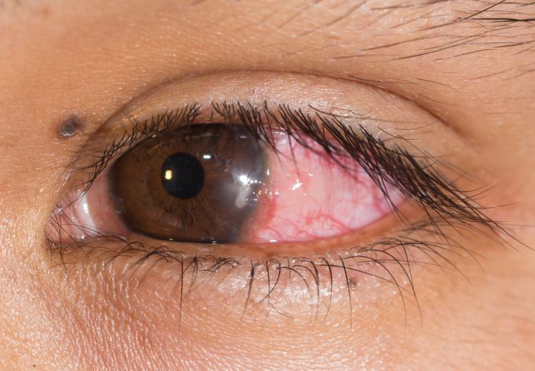 red eye due to inflammation