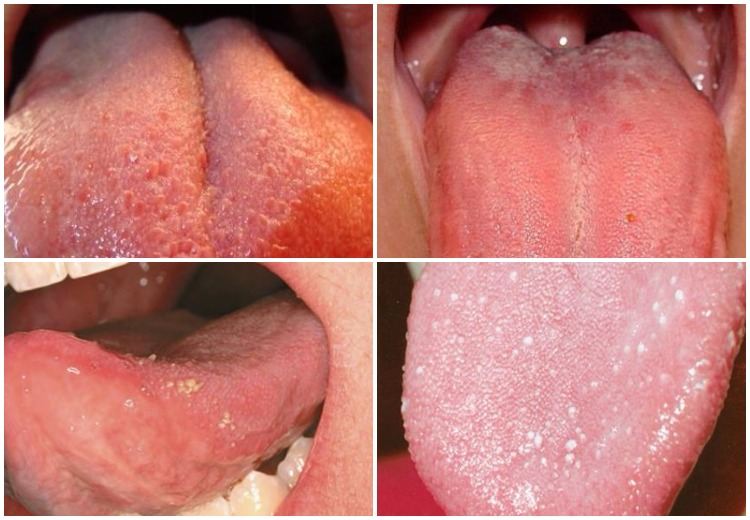 Swollen taste buds on tip, back and side of the tongue