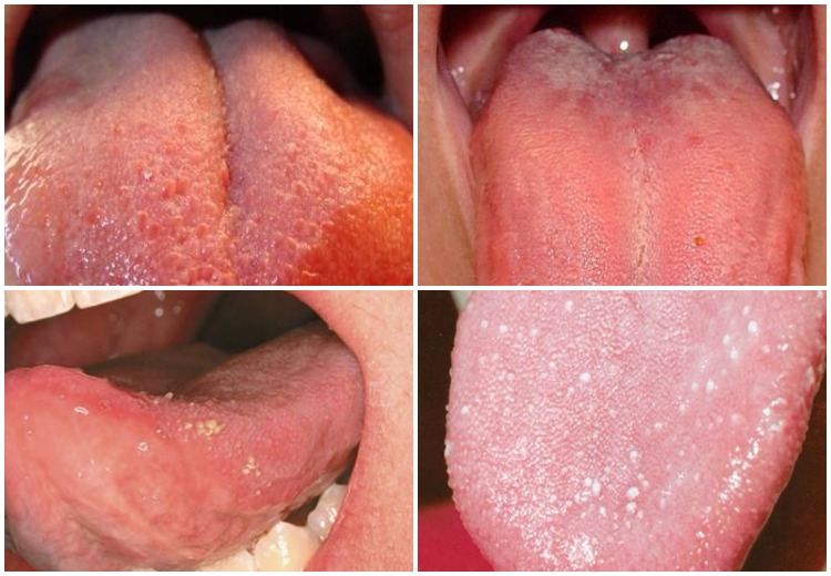 swollen taste buds side of tongue