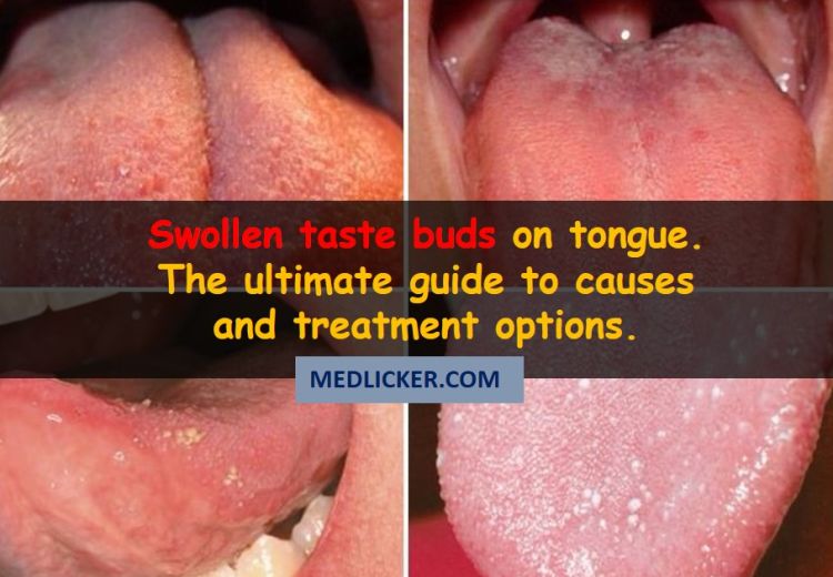 swollen taste buds side of tongue