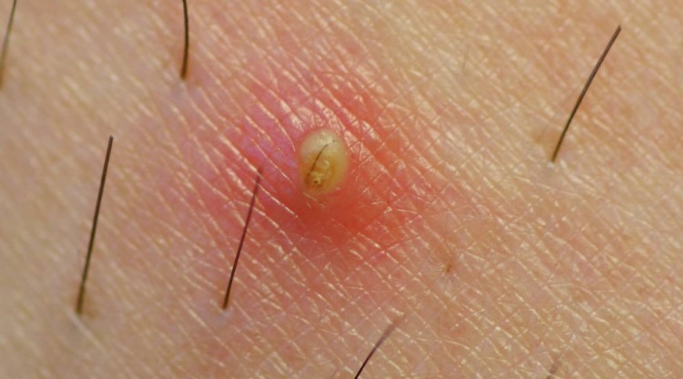 Ingrown hair cyst with pus