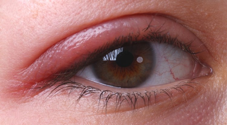 What are some causes of red, itchy eyelids?