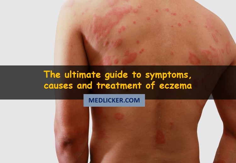 All about eczema: causes, symptoms, treatment and prevention