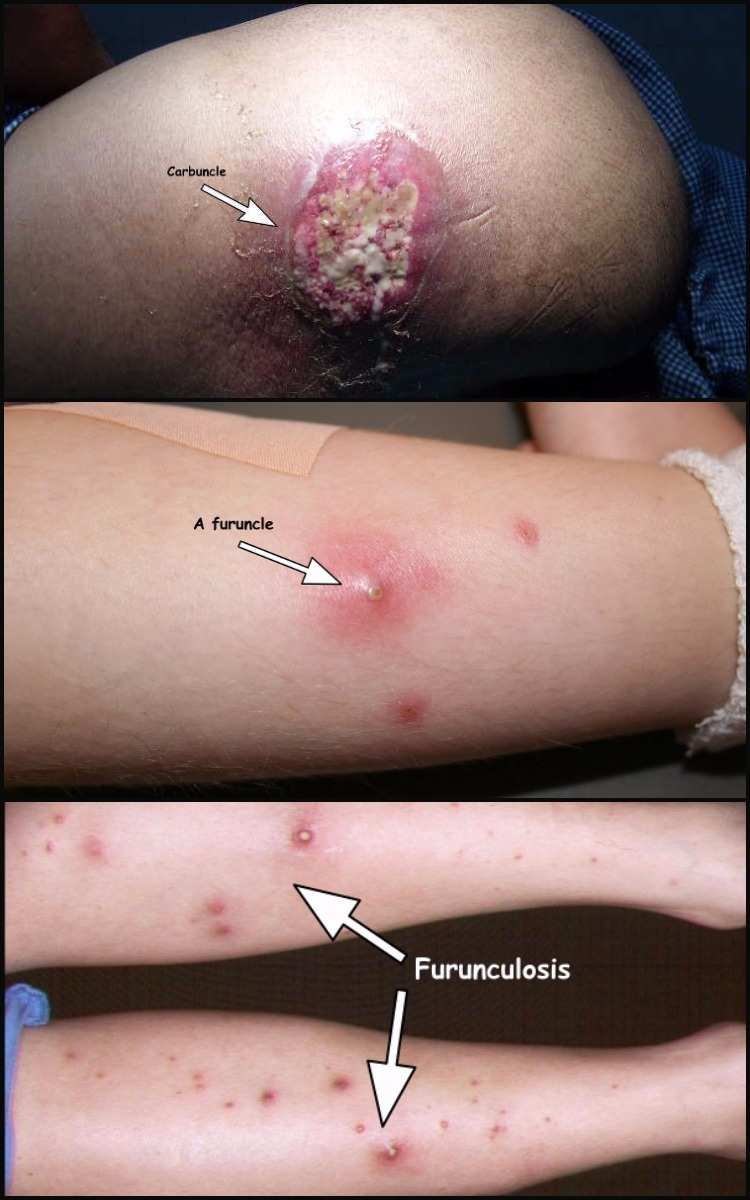 Furuncle, carbuncle and furunculosis compared