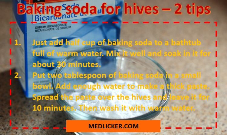 How to use baking soda for hives?