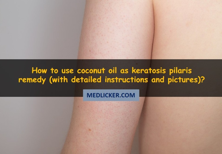 How to use coconut oil as a home remedy for keratosis pilaris?