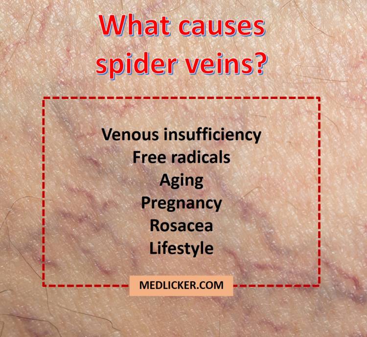 Overview of causes of spider veins